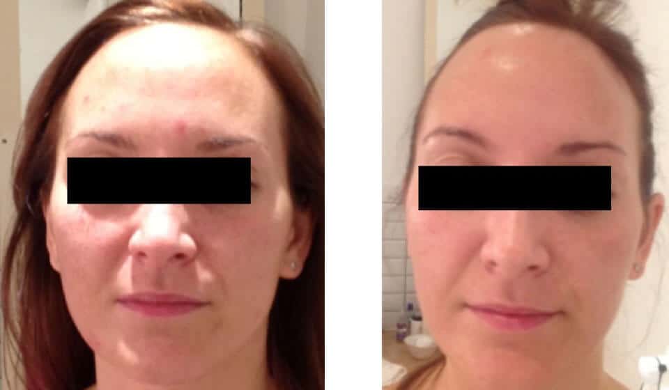 Dermalux LED Phototherapy